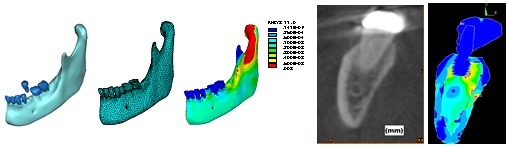FEA of jaw and implant